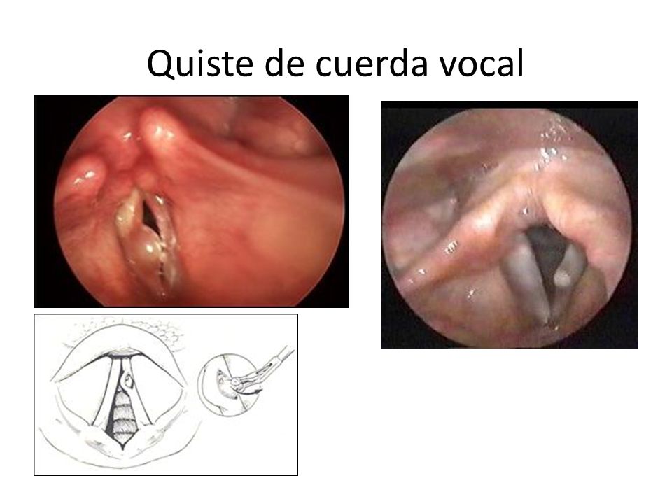 quiste mucoso cuerda vocal